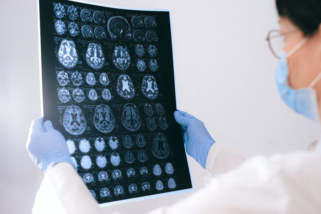 Epilepsia IA AI Inteligencia Artificial